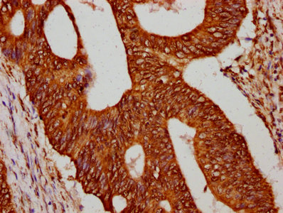HIST1H4I Antibody - Immunohistochemistry Dilution at 1:75 and staining in paraffin-embedded human colon cancer performed on a Leica BondTM system. After dewaxing and hydration, antigen retrieval was mediated by high pressure in a citrate buffer (pH 6.0). Section was blocked with 10% normal Goat serum 30min at RT. Then primary antibody (1% BSA) was incubated at 4°C overnight. The primary is detected by a biotinylated Secondary antibody and visualized using an HRP conjugated SP system.