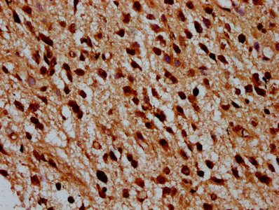 HIST1H4I Antibody - Immunohistochemistry Dilution at 1:100 and staining in paraffin-embedded human glioma cancer performed on a Leica BondTM system. After dewaxing and hydration, antigen retrieval was mediated by high pressure in a citrate buffer (pH 6.0). Section was blocked with 10% normal Goat serum 30min at RT. Then primary antibody (1% BSA) was incubated at 4°C overnight. The primary is detected by a biotinylated Secondary antibody and visualized using an HRP conjugated SP system.