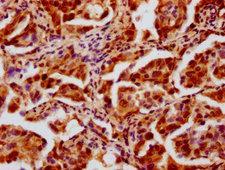 HIST1H4I Antibody - Immunohistochemistry Dilution at 1:20 and staining in paraffin-embedded human lung cancer performed on a Leica BondTM system. After dewaxing and hydration, antigen retrieval was mediated by high pressure in a citrate buffer (pH 6.0). Section was blocked with 10% normal Goat serum 30min at RT. Then primary antibody (1% BSA) was incubated at 4°C overnight. The primary is detected by a biotinylated Secondary antibody and visualized using an HRP conjugated SP system.