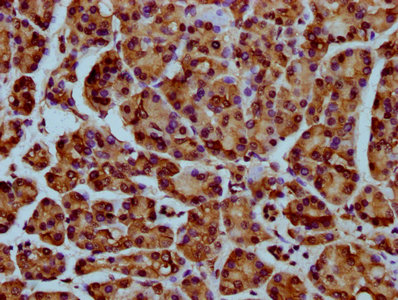 HIST1H4I Antibody - Immunohistochemistry Dilution at 1:25 and staining in paraffin-embedded human pancreatic cancer performed on a Leica BondTM system. After dewaxing and hydration, antigen retrieval was mediated by high pressure in a citrate buffer (pH 6.0). Section was blocked with 10% normal Goat serum 30min at RT. Then primary antibody (1% BSA) was incubated at 4°C overnight. The primary is detected by a biotinylated Secondary antibody and visualized using an HRP conjugated SP system.