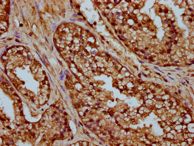 HIST1H4I Antibody - Immunohistochemistry Dilution at 1:25 and staining in paraffin-embedded human prostate cancer performed on a Leica BondTM system. After dewaxing and hydration, antigen retrieval was mediated by high pressure in a citrate buffer (pH 6.0). Section was blocked with 10% normal Goat serum 30min at RT. Then primary antibody (1% BSA) was incubated at 4°C overnight. The primary is detected by a biotinylated Secondary antibody and visualized using an HRP conjugated SP system.