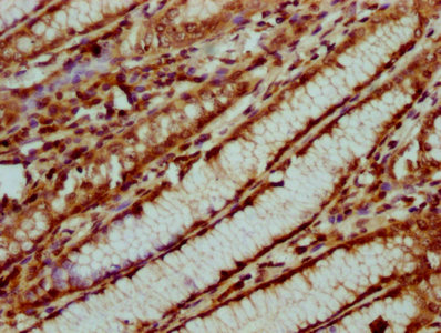 HIST1H4I Antibody - Immunohistochemistry Dilution at 1:20 and staining in paraffin-embedded human gastric cancer performed on a Leica BondTM system. After dewaxing and hydration, antigen retrieval was mediated by high pressure in a citrate buffer (pH 6.0). Section was blocked with 10% normal Goat serum 30min at RT. Then primary antibody (1% BSA) was incubated at 4°C overnight. The primary is detected by a biotinylated Secondary antibody and visualized using an HRP conjugated SP system.