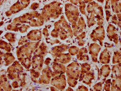 HIST1H4I Antibody - Immunohistochemistry Dilution at 1:20 and staining in paraffin-embedded human pancreatic cancer performed on a Leica BondTM system. After dewaxing and hydration, antigen retrieval was mediated by high pressure in a citrate buffer (pH 6.0). Section was blocked with 10% normal Goat serum 30min at RT. Then primary antibody (1% BSA) was incubated at 4°C overnight. The primary is detected by a biotinylated Secondary antibody and visualized using an HRP conjugated SP system.
