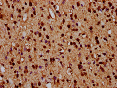 HIST1H4I Antibody - Immunohistochemistry Dilution at 1:3 and staining in paraffin-embedded human glioma cancer performed on a Leica BondTM system. After dewaxing and hydration, antigen retrieval was mediated by high pressure in a citrate buffer (pH 6.0). Section was blocked with 10% normal Goat serum 30min at RT. Then primary antibody (1% BSA) was incubated at 4°C overnight. The primary is detected by a biotinylated Secondary antibody and visualized using an HRP conjugated SP system.