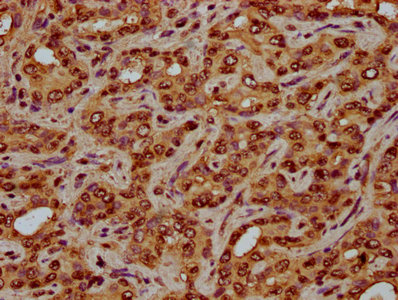 HIST1H4I Antibody - Immunohistochemistry Dilution at 1:3 and staining in paraffin-embedded human liver cancer performed on a Leica BondTM system. After dewaxing and hydration, antigen retrieval was mediated by high pressure in a citrate buffer (pH 6.0). Section was blocked with 10% normal Goat serum 30min at RT. Then primary antibody (1% BSA) was incubated at 4°C overnight. The primary is detected by a biotinylated Secondary antibody and visualized using an HRP conjugated SP system.