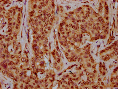 HIST1H4I Antibody - Immunohistochemistry Dilution at 1:10 and staining in paraffin-embedded human liver cancer performed on a Leica BondTM system. After dewaxing and hydration, antigen retrieval was mediated by high pressure in a citrate buffer (pH 6.0). Section was blocked with 10% normal Goat serum 30min at RT. Then primary antibody (1% BSA) was incubated at 4°C overnight. The primary is detected by a biotinylated Secondary antibody and visualized using an HRP conjugated SP system.