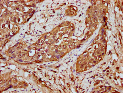 HIST1H4I Antibody - Immunohistochemistry Dilution at 1:20 and staining in paraffin-embedded human cervical cancer performed on a Leica BondTM system. After dewaxing and hydration, antigen retrieval was mediated by high pressure in a citrate buffer (pH 6.0). Section was blocked with 10% normal Goat serum 30min at RT. Then primary antibody (1% BSA) was incubated at 4°C overnight. The primary is detected by a biotinylated Secondary antibody and visualized using an HRP conjugated SP system.
