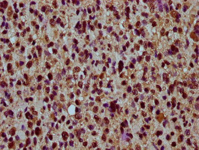 HIST1H4I Antibody - Immunohistochemistry Dilution at 1:30 and staining in paraffin-embedded human glioma cancer performed on a Leica BondTM system. After dewaxing and hydration, antigen retrieval was mediated by high pressure in a citrate buffer (pH 6.0). Section was blocked with 10% normal Goat serum 30min at RT. Then primary antibody (1% BSA) was incubated at 4°C overnight. The primary is detected by a biotinylated Secondary antibody and visualized using an HRP conjugated SP system.