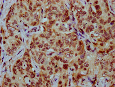 HIST1H4I Antibody - Immunohistochemistry Dilution at 1:20 and staining in paraffin-embedded human liver cancer performed on a Leica BondTM system. After dewaxing and hydration, antigen retrieval was mediated by high pressure in a citrate buffer (pH 6.0). Section was blocked with 10% normal Goat serum 30min at RT. Then primary antibody (1% BSA) was incubated at 4°C overnight. The primary is detected by a biotinylated Secondary antibody and visualized using an HRP conjugated SP system.