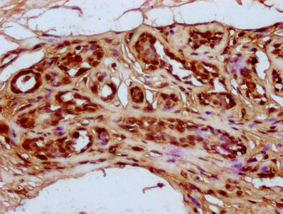 HIST1H4I Antibody - Immunohistochemistry Dilution at 1:20 and staining in paraffin-embedded human breast cancer performed on a Leica BondTM system. After dewaxing and hydration, antigen retrieval was mediated by high pressure in a citrate buffer (pH 6.0). Section was blocked with 10% normal Goat serum 30min at RT. Then primary antibody (1% BSA) was incubated at 4°C overnight. The primary is detected by a biotinylated Secondary antibody and visualized using an HRP conjugated SP system.