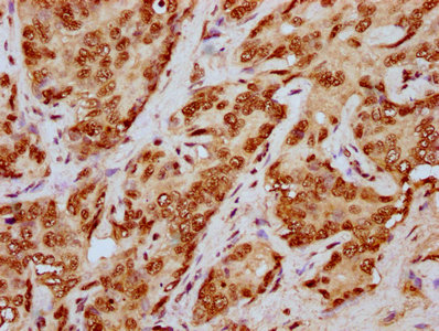 HIST1H4I Antibody - Immunohistochemistry Dilution at 1:20 and staining in paraffin-embedded human liver cancer performed on a Leica BondTM system. After dewaxing and hydration, antigen retrieval was mediated by high pressure in a citrate buffer (pH 6.0). Section was blocked with 10% normal Goat serum 30min at RT. Then primary antibody (1% BSA) was incubated at 4°C overnight. The primary is detected by a biotinylated Secondary antibody and visualized using an HRP conjugated SP system.
