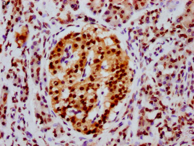 HIST1H4I Antibody - Immunohistochemistry Dilution at 1:20 and staining in paraffin-embedded human pancreatic cancer performed on a Leica BondTM system. After dewaxing and hydration, antigen retrieval was mediated by high pressure in a citrate buffer (pH 6.0). Section was blocked with 10% normal Goat serum 30min at RT. Then primary antibody (1% BSA) was incubated at 4°C overnight. The primary is detected by a biotinylated Secondary antibody and visualized using an HRP conjugated SP system.