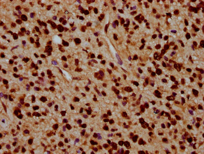 HIST1H4I Antibody - Immunohistochemistry Dilution at 1:5 and staining in paraffin-embedded human glioma cancer performed on a Leica BondTM system. After dewaxing and hydration, antigen retrieval was mediated by high pressure in a citrate buffer (pH 6.0). Section was blocked with 10% normal Goat serum 30min at RT. Then primary antibody (1% BSA) was incubated at 4°C overnight. The primary is detected by a biotinylated Secondary antibody and visualized using an HRP conjugated SP system.