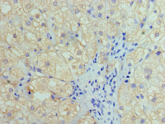 HIST1H4I Antibody - Paraffin-embedding Immunohistochemistry using human liver cancer at dilution 1:100