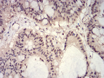 HIST2H3C Antibody - Immunohistochemical analysis of paraffin-embedded colon cancer tissues using HIST2H3C(27Ac) mouse mAb with DAB staining.