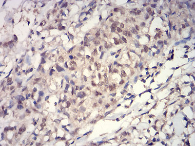 HIST2H3C Antibody - Immunohistochemical analysis of paraffin-embedded breast cancer tissues using HIST2H3C(27Ac) mouse mAb with DAB staining.