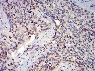 HIST2H3C Antibody - Immunohistochemical analysis of paraffin-embedded cervical cancer tissues using HIST2H3C(27Ac) mouse mAb with DAB staining.