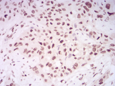 HIST2H4A Antibody - Immunohistochemical analysis of paraffin-embedded esophageal cancer tissues using HIST2H4A(20Me) mouse mAb with DAB staining.