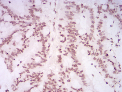 HIST2H4A Antibody - Immunohistochemical analysis of paraffin-embedded colon cancer tissues using HIST2H4A(20Me) mouse mAb with DAB staining.