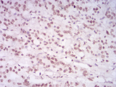 HIST2H4A Antibody - Immunohistochemical analysis of paraffin-embedded stomach cancer tissues using HIST2H4A(20Me) mouse mAb with DAB staining.