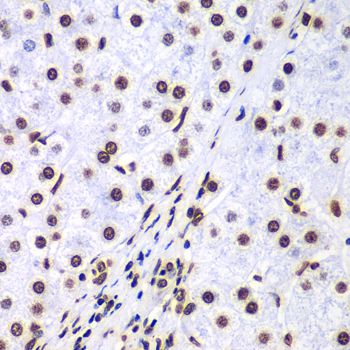 HIST3H3 Antibody - Immunohistochemistry of paraffin-embedded human liver cancer using HIST3H3 antibody at dilution of 1:100 (40x lens).