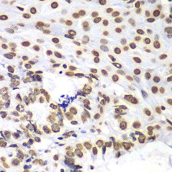 HIST3H3 Antibody - Immunohistochemistry of paraffin-embedded human oophoroma using HIST3H3 antibody at dilution of 1:100 (40x lens).