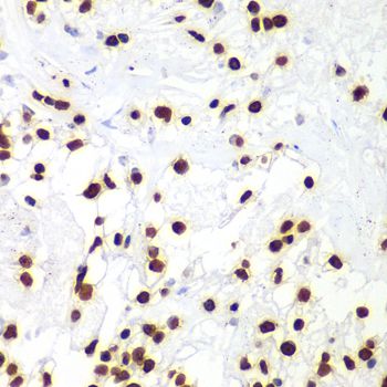 HIST3H3 Antibody - Immunohistochemistry of paraffin-embedded human kidney cancer using HIST3H3 antibody at dilution of 1:100 (40x lens).