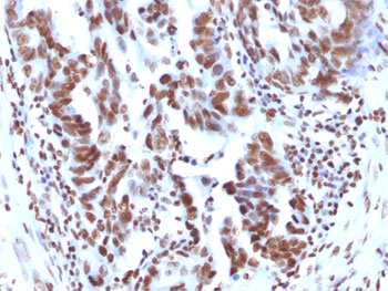 Histone Antibody - FFPE human ovarian carcinoma tested with Histone H1 antibody (1415-1).  This image was taken for the unmodified form of this product. Other forms have not been tested.