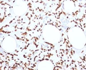Histone Antibody - FFPE human angiosarcoma tested with Histone H1 antibody (1415-1).  This image was taken for the unmodified form of this product. Other forms have not been tested.
