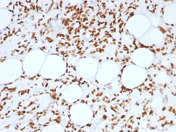 Histone Antibody - FFPE human angiosarcoma tested with Histone antibody (AE-4).  This image was taken for the unmodified form of this product. Other forms have not been tested.