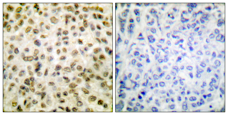 Histone H1 Antibody - Immunohistochemistry analysis of paraffin-embedded human breast carcinoma tissue, using Histone H1 (Acetyl-Lys25) Antibody. The picture on the right is blocked with the synthesized peptide.