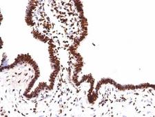 Histone H1 Antibody - Formalin-fixed, paraffin-embedded human ovarian carcinoma stained with Histone H1 antibody (HH1/957).  This image was taken for the unmodified form of this product. Other forms have not been tested.