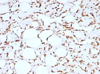 Histone H1 Antibody - FFPE human angiosarcoma tested with Histone H1 antibody (HH1/957).  This image was taken for the unmodified form of this product. Other forms have not been tested.