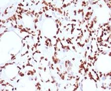 Histone H1 Antibody - IHC testing of FFPE human angiosarcoma and Histone H1 antibody (clone OSHT-2).  This image was taken for the unmodified form of this product. Other forms have not been tested.