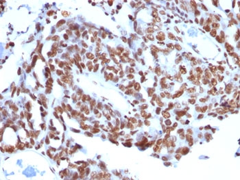 Histone H1 Antibody - FFPE human ovarian carcinoma tested with anti-Histone H1 antibody (SPM256).  This image was taken for the unmodified form of this product. Other forms have not been tested.