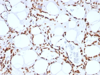 Histone H1 Antibody - FFPE human angiosarcoma tested with anti-Histone H1 antibody (SPM256).  This image was taken for the unmodified form of this product. Other forms have not been tested.
