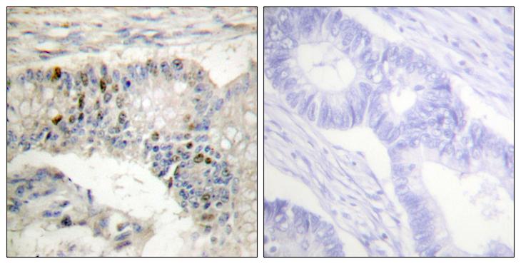 Histone H1 Antibody - Peptide - + Immunohistochemistry analysis of paraffin-embedded human colon carcinoma tissue using Histone H1 (Ab-17) antibody.