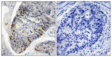 Histone H1 Antibody - Immunohistochemistry analysis of paraffin-embedded human colon carcinoma, using Histone H1 (Phospho-Thr17) Antibody. The picture on the right is blocked with the phospho peptide.