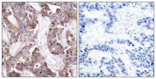 Histone H1 Antibody - P-peptide - + Immunohistochemistry analysis of paraffin-embedded human colon carcinoma tissue using Histone H1 (Phospho-Thr17) antibody.