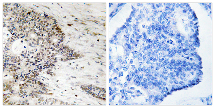 Histone H2A Antibody - Immunohistochemistry analysis of paraffin-embedded human colon carcinoma, using Histone H2A (Phospho-Thr121) Antibody. The picture on the right is blocked with the phospho peptide.
