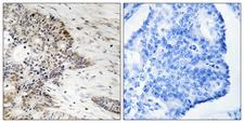 Histone H2A Antibody - Immunohistochemistry analysis of paraffin-embedded human colon carcinoma, using Histone H2A (Phospho-Thr121) Antibody. The picture on the right is blocked with the phospho peptide.