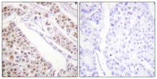 Histone H2B Antibody - Immunohistochemistry analysis of paraffin-embedded human lung carcinoma tissue, using Histone H2B (Acetyl-Lys12) Antibody. The picture on the right is blocked with the synthesized peptide.