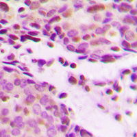 Histone H2B Antibody - Immunohistochemical analysis of Histone H2B (AcK12) staining in human breast cancer formalin fixed paraffin embedded tissue section. The section was pre-treated using heat mediated antigen retrieval with sodium citrate buffer (pH 6.0). The section was then incubated with the antibody at room temperature and detected using an HRP conjugated compact polymer system. DAB was used as the chromogen. The section was then counterstained with hematoxylin and mounted with DPX.