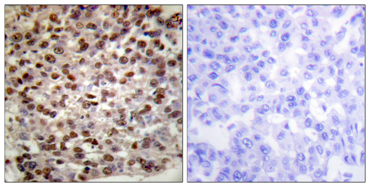 Histone H2B Antibody - Immunohistochemistry analysis of paraffin-embedded human breast carcinoma tissue, using Histone H2B (Acetyl-Lys15) Antibody. The picture on the right is blocked with the synthesized peptide.