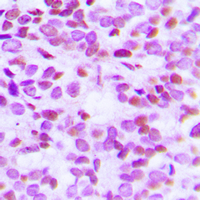 Histone H2B Antibody - Immunohistochemical analysis of Histone H2B (AcK15) staining in human breast cancer formalin fixed paraffin embedded tissue section. The section was pre-treated using heat mediated antigen retrieval with sodium citrate buffer (pH 6.0). The section was then incubated with the antibody at room temperature and detected using an HRP conjugated compact polymer system. DAB was used as the chromogen. The section was then counterstained with hematoxylin and mounted with DPX.