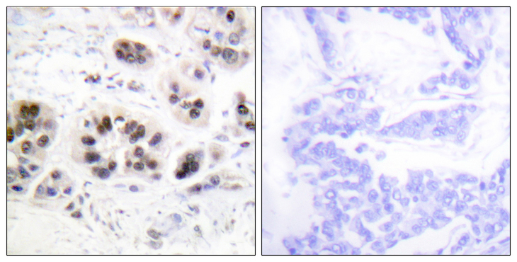 Histone H2B Antibody - Immunohistochemistry analysis of paraffin-embedded human breast carcinoma tissue, using Histone H2A (Acetyl-Lys5) Antibody. The picture on the right is blocked with the synthesized peptide.