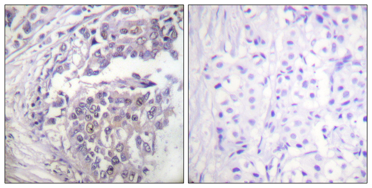 Histone H2B Antibody - Immunohistochemistry analysis of paraffin-embedded human breast carcinoma tissue, using Histone H2B (Acetyl-Lys5) Antibody. The picture on the right is blocked with the synthesized peptide.