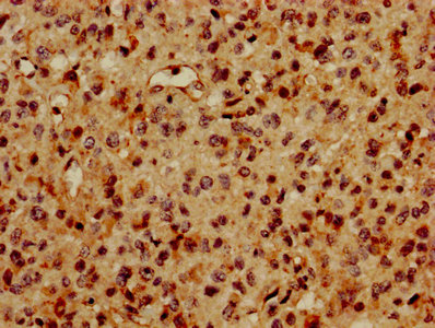 Histone H2B Antibody - IHC image of HIST1H2BC Antibody diluted at 1:600 and staining in paraffin-embedded human glioma performed on a Leica BondTM system. After dewaxing and hydration, antigen retrieval was mediated by high pressure in a citrate buffer (pH 6.0). Section was blocked with 10% normal goat serum 30min at RT. Then primary antibody (1% BSA) was incubated at 4°C overnight. The primary is detected by a biotinylated secondary antibody and visualized using an HRP conjugated SP system.