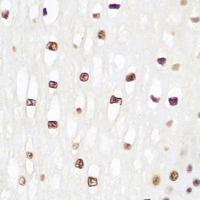 Histone H2B Antibody - Immunohistochemical analysis of Histone H2B staining in human esophageal cancer formalin fixed paraffin embedded tissue section. The section was pre-treated using heat mediated antigen retrieval with sodium citrate buffer (pH 6.0). The section was then incubated with the antibody at room temperature and detected using an HRP conjugated compact polymer system. DAB was used as the chromogen. The section was then counterstained with hematoxylin and mounted with DPX.