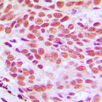 Histone H2B Antibody - Immunohistochemical analysis of Histone H2B staining in human breast cancer formalin fixed paraffin embedded tissue section. The section was pre-treated using heat mediated antigen retrieval with sodium citrate buffer (pH 6.0). The section was then incubated with the antibody at room temperature and detected using an HRP conjugated compact polymer system. DAB was used as the chromogen. The section was then counterstained with hematoxylin and mounted with DPX.